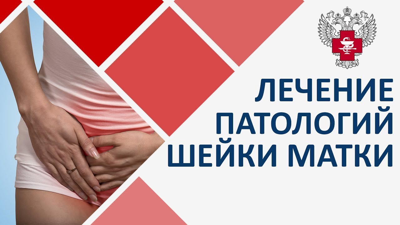 Патология шейки матки. Современное малоинвазивное лечение патологии шейки матки смотреть онлайн