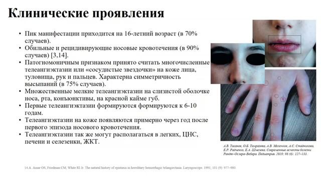 Редкий вариант первичной цилиарной дискинезии в сочетании с наследственной геморрагической телеанги смотреть онлайн