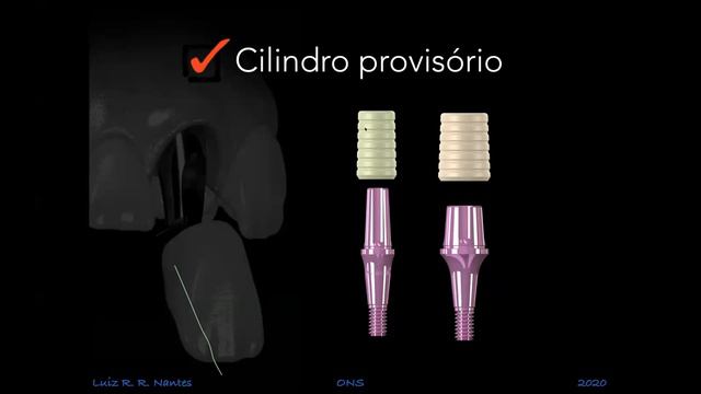 Selección de aditamentos protésicos en Implantología смотреть онлайн