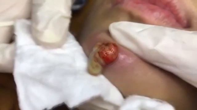 Давим прыщи. Лопнул огромный прыщ на подмышке! Видео с прыщами 2021 залипательно. смотреть онлайн