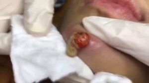 Давим прыщи. Лопнул огромный прыщ на подмышке! Видео с прыщами 2021 залипательно.