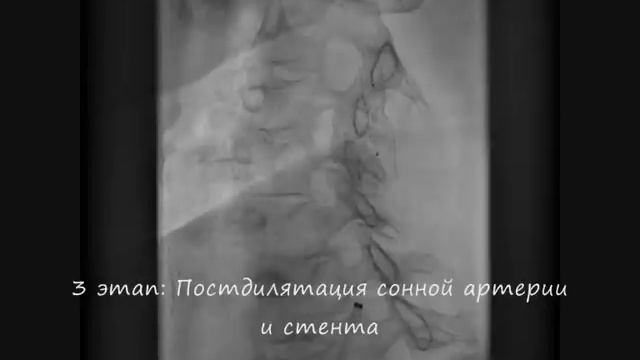 Стентирование сонных артерий смотреть онлайн