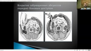 Осложнения острого аппендицита