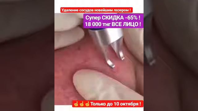 Удаление сосудов лазером смотреть онлайн