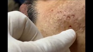 Remoção de cravo 2021 - Pimple Popping 2021- Blackhead Removal 009