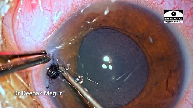 Pencil Injury to the eye . Pencil Lead Stuck inside..! Tips to remove the FB - Dr Deepak Megur смотреть онлайн