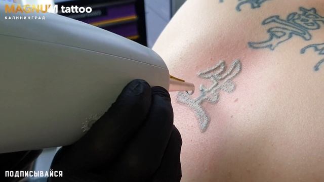 Лазерное удаление татуировок Калининград - Magnum Tattoo смотреть онлайн