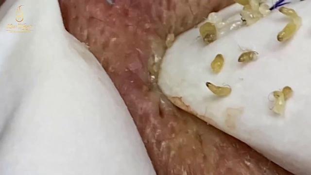The small blackheads grains of rice | Loan Nguyen смотреть онлайн