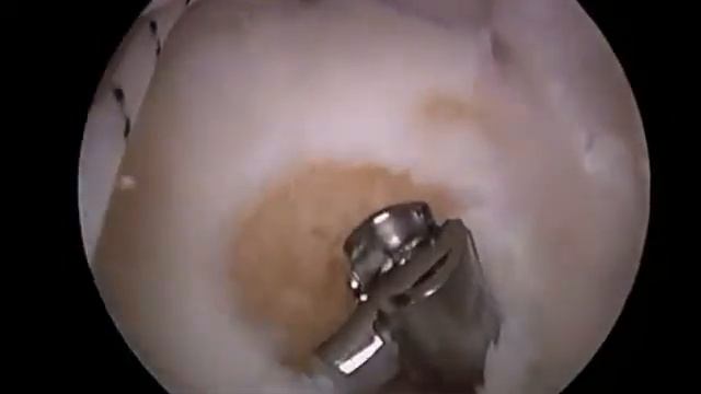 Lateral Meniscus Allograft Transplantation: The Bone Plug Technique смотреть онлайн