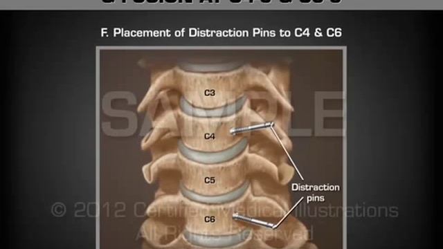 Передне-цервикальная дискэктомия и фиксация позвонков С4-5 и С5-6