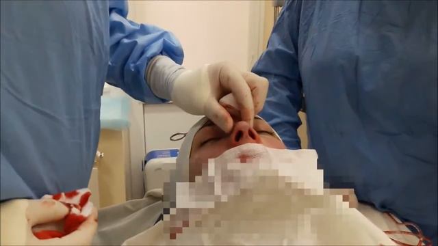 Закрита ринопластика Closed rhinoplasty Руслан Гуменний смотреть онлайн