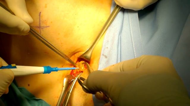 sentinel lymph node dissection in breast cancer - combined technique смотреть онлайн