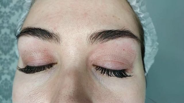 Блефаропластика плазмой. г. Домодедово смотреть онлайн