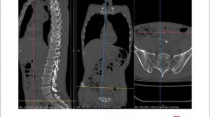 КТ грудного и поясничного отдела позвоночника «Синдром тающего сахара» от компании Честная Медицина
