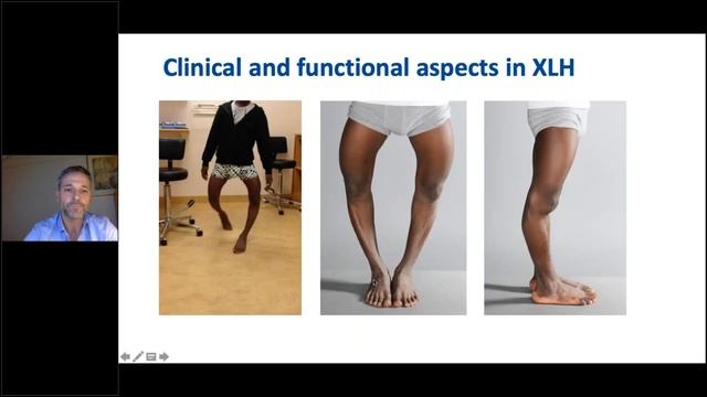 8th EPOS Webinar on Lower Limb смотреть онлайн