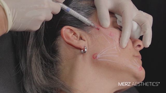 Bioestimulacion Con Radiesse De Merz