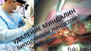 УДАЛЕНИЕ МИНДАЛИН БИПОЛЯРНЫМ ПИНЦЕТОМ оперирует ЛОР-хирург к.м.н. Фуки Евгений Михайлович