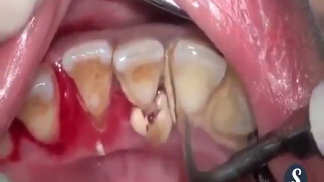 Зубной камень смотреть онлайн