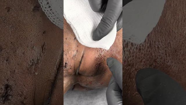 Part 2 😏😏😏😏😏 Nevus Comedonicus смотреть онлайн