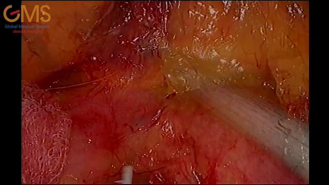 Laparoscopic right hemicolectomy with D3 lymph node dissection for hepatic flexure cancer смотреть онлайн