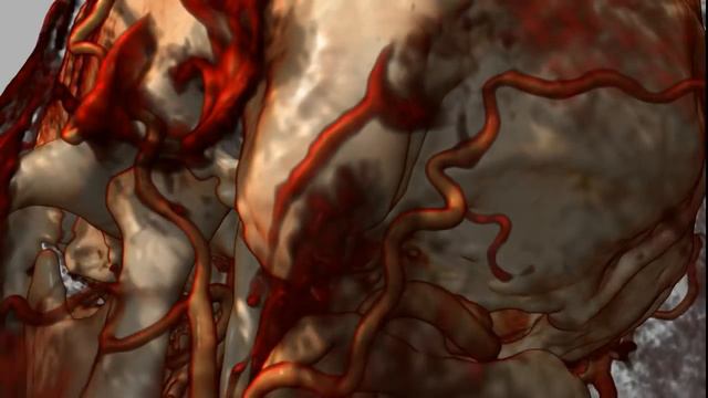 CT scan of the brain vessels смотреть онлайн