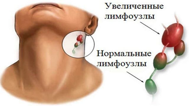 ВИРУС ЭПШТЕЙН БАРР смотреть онлайн