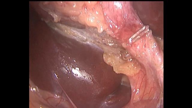 Laparoscopic cholecystectomy приключения брутальных хирургов 48 смотреть онлайн