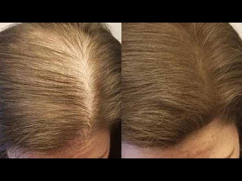 Выпадают волосы_! Это Средство ждут Все! Сильная маска от Выпадения волос! смотреть онлайн