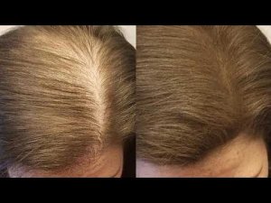 Выпадают волосы_! Это Средство ждут Все! Сильная маска от Выпадения волос!