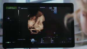 ЧТО ДЕЛАЕТ РЕБЕНОК В ЖИВОТЕ ВО ВРЕМЯ УЗИ | 5 интересных вещей которые вытворяет малыш во время УЗИ