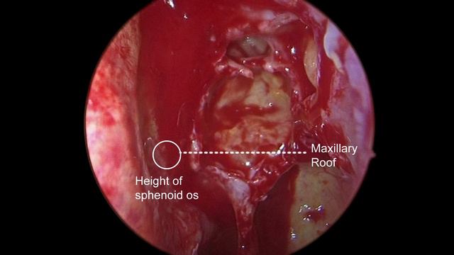 Full Functional Endoscopic Sinus Surgery (FESS) for sinusitis смотреть онлайн