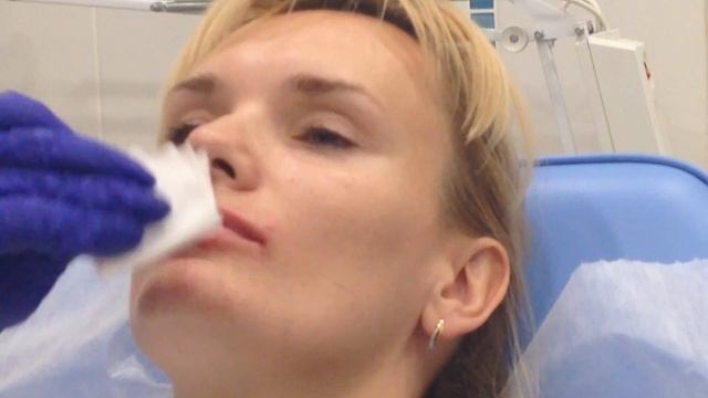 Меди лайт: Применение филлеров при увеличении объема губ смотреть онлайн