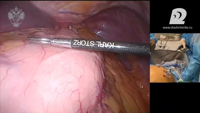 ШКОЛА ХИРУРГИИ ЖЕЛУДКА 2015 Тораколапароскопическая эзофагэктомия II смотреть онлайн