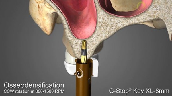 Versah New Universal Guided Surgery Densah Bur System