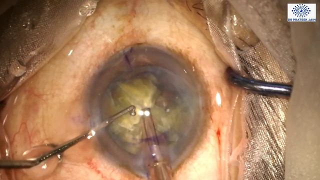 #173 Topical Phaco in advance nucleus sclerosis with Tecnis Toric IOL hydro-implantation смотреть онлайн