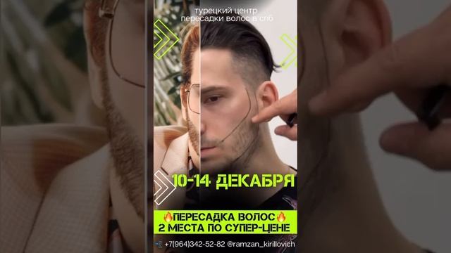 Пересадка волос на бороду в СПб. Ищи нас в инст.: @Shineyourhair.spb #пересадкабороды