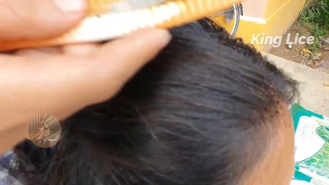 Omg Thousand big lice on lady head - Lice removal смотреть онлайн
