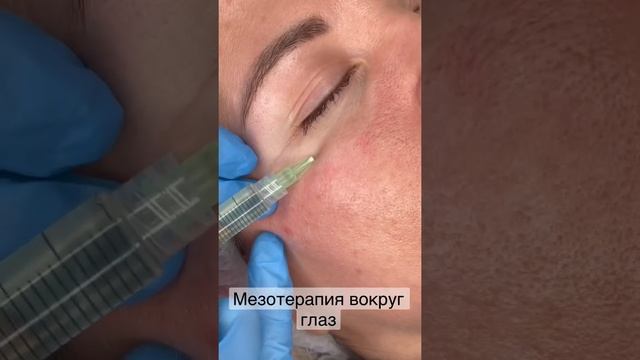 Мезотерапия вокруг глаз смотреть онлайн