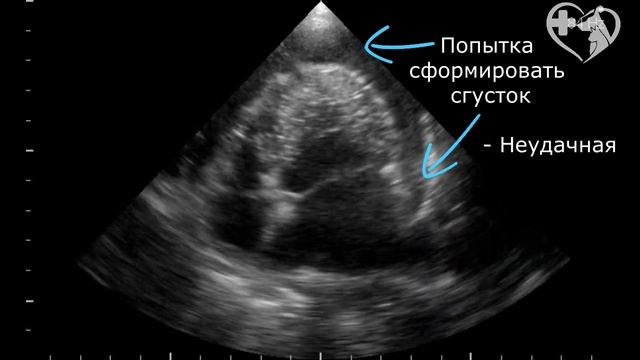 Разрыв левого предсердия у собак с эндокардиозом
