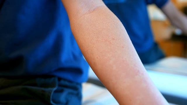 HIVES EVERYWHERE! (What Caused This Allergic Reaction?) | Dr. Paul смотреть онлайн