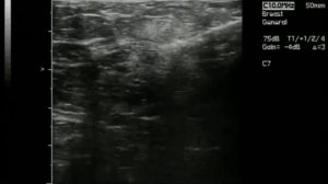 Возможности Vacora® при визуализации с помощью УЗИ