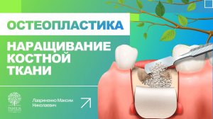 ? Остеопластика - наращивание костной ткани