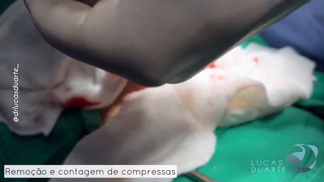 Apendicectomia 4K - Appendectomy • DR. LUCAS DUARTE [01MAR22] смотреть онлайн