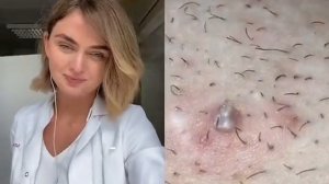 Удаляем вросший волос