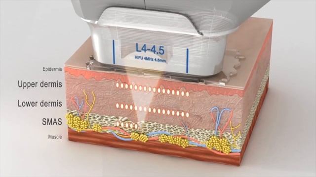 SMAS lifting Ultraformer 3. СМАС лифтинг и комплексное моделирование лица смотреть онлайн