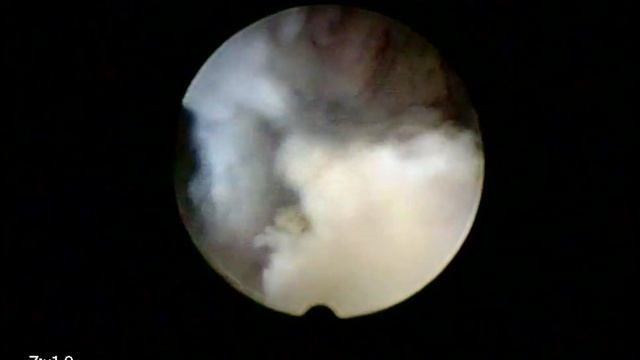 Septum Uteri Biolitec Laser 01 10