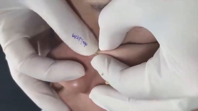 угри лечения | | Как удалить прыщи, извлечь черные головы. смотреть онлайн