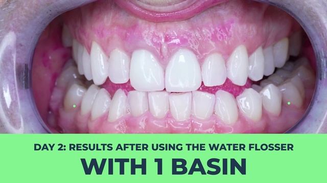 Dentist Reviews WATER FLOSSER For Teeth vs. String Floss!! Before & After of Plaque Removal Efficac смотреть онлайн