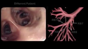 Эндоскопическая анатомия трахеобронхиального дерева