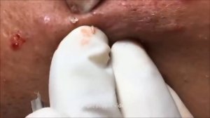 ВЫДАВЛИВАЕМ БОЛЬШИЕ ЧЕРНЫЕ ТОЧКИ, ВЫДАВЛИВАЕМ ПРЫЩИ Под расслабляющую музыку